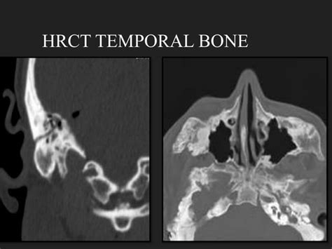 HRCT CHEST/TEMPORAL BONE PROTOCOL.pptx