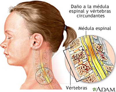 Lesión a la médula espinal MedlinePlus enciclopedia médica illustración