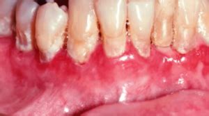 What is Mucous Membrane Pemphigoid?