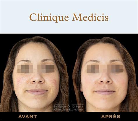 Hydrafacial Skin Treatment Paris Dr Abbou Et Dr Pessis