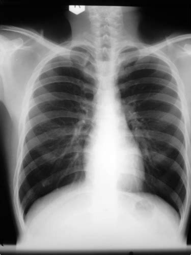 Rt Clinical Application Of The Chest Radiograph Part