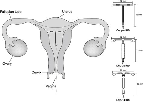 Paragard Iud Diagram