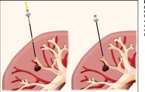 Figure 1 From Complications Of CT Guided Percutaneous Needle Biopsy Of