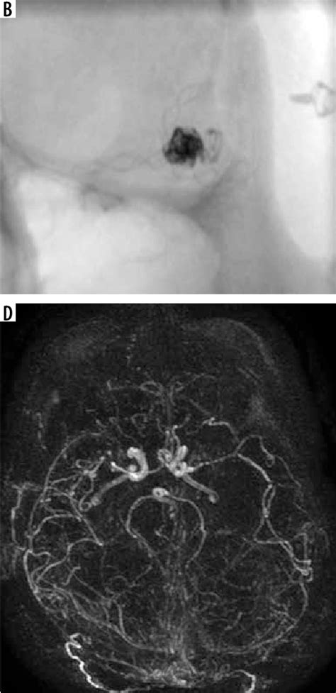 Figure 2 From Endovascular Treatment Of Middle Cerebral Artery Aneurysms Single Centre Results