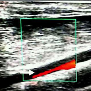 Ultrasound image shows superficial femoral artery partial thrombus on... | Download Scientific ...