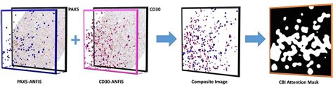 Sample CD30 positive cell population, and PAX5 semi-positive cell ...