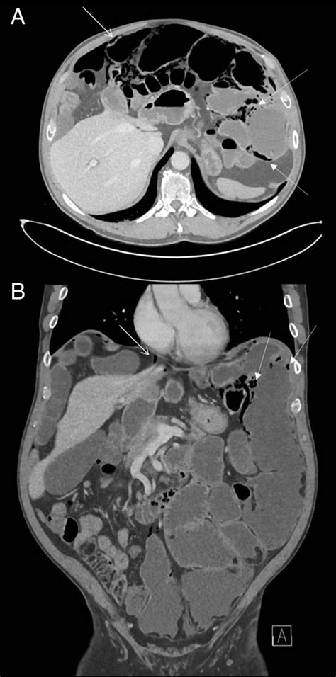 A Axial Section From An Abdominal Computed Tomography Ct Showing