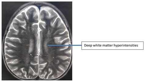 MRI of the brain: multiple enhancing confluent white matter lesions of ...