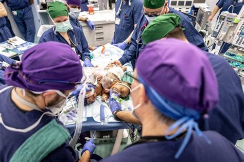 Conjoined Twin Sisters Undergo Successful Surgery To Separate At 4 Months Old