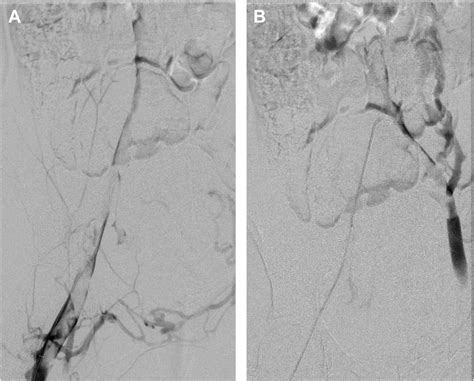 Diagnostic Venogram Demonstrating Extensive Thrombus Burden In The