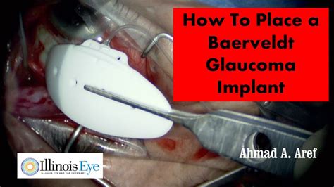 How To Place A Baerveldt Glaucoma Implant YouTube