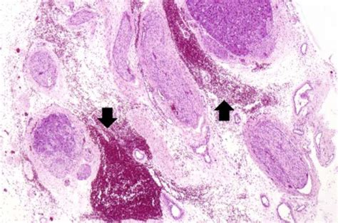 IPLab:Lab 13:Myelomeningocele - Pathology Education Instructional Resource