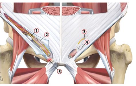 Causas De Dolor De Cadera Dolor Inguinal Relacionado Con El Ligamento Inguinal Clínica Igon