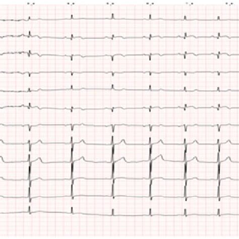 Twelve Lead Electrocardiogram Showing Sinus Rhythm With St Segment