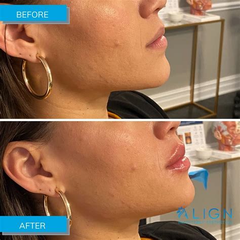 Before After Results Align Injectable Aesthetics