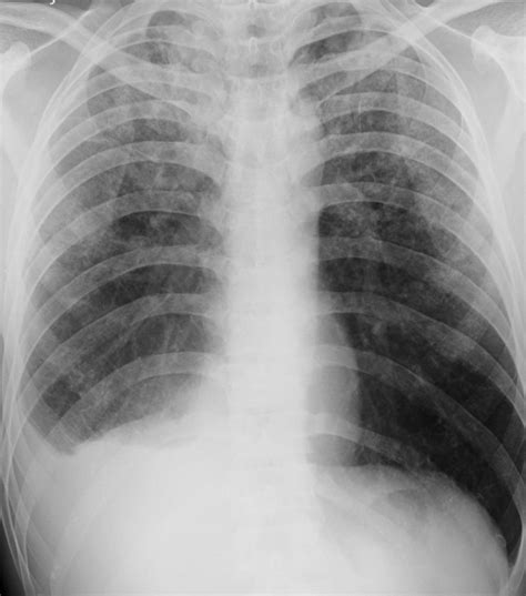 Chest Radiograph Interpretation Oscestop Osce Learning