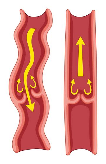 Deep Vein Thrombosis Dvt Treatments Monterey Bay Vascular