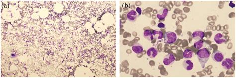 Effective Treatment Of Refractory Acquired Pure Red Blood Cell Aplasia