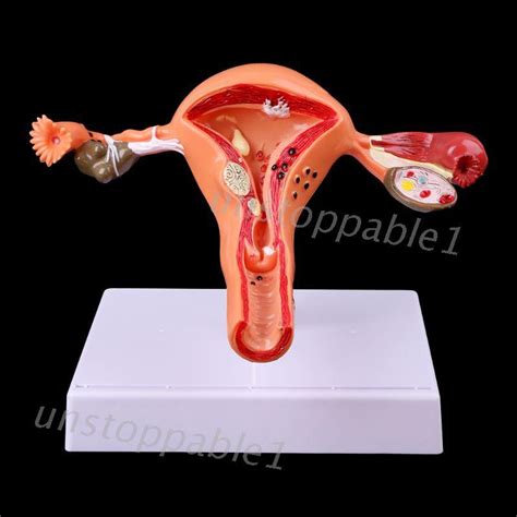 Pathological Uterus Ovary Anatomical Model Anatomy Cross Section Study