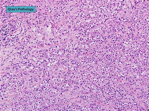 Flickriver Photoset Invasive Lobular Carcinoma With Extracellular