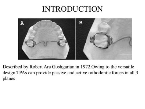 Trans Palatal Arch