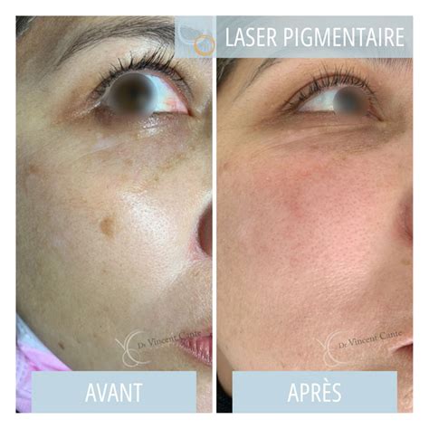 Traitement Des T Ches Brunes Par Laser Pigmentaire Bordeaux