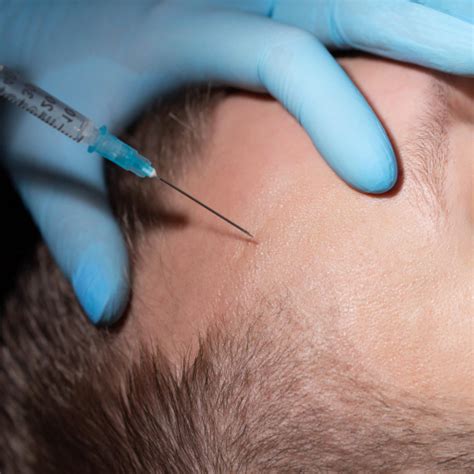 Prp For Hair Restoration Hair Transplant Specialists Nyc