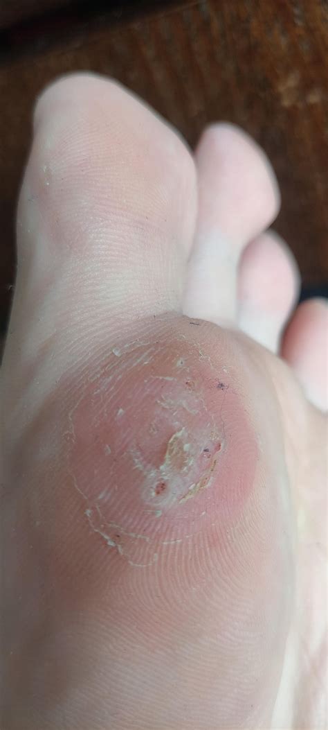 wart treatment : r/Warts