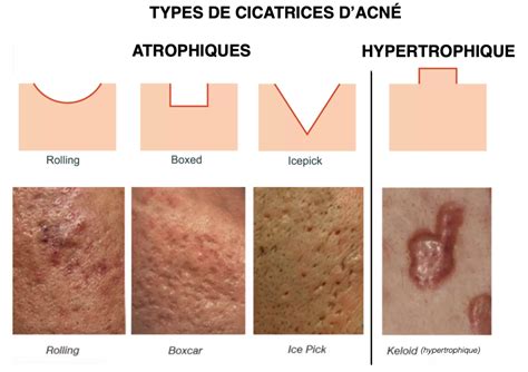 Types cicatrices hypertrophiques chéloïdes atrophique et rétractile