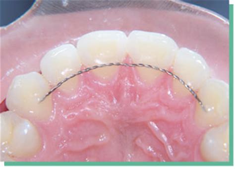 Cleaning Bonded Retainers | Wexford Orthodontics