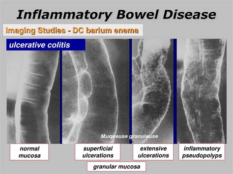 Ppt Inflammatory Bowel Disease Powerpoint Presentation Free Download Id6712579