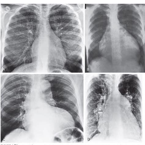 For Each Of The Chest Radiographs Shown In Figure Match The Most