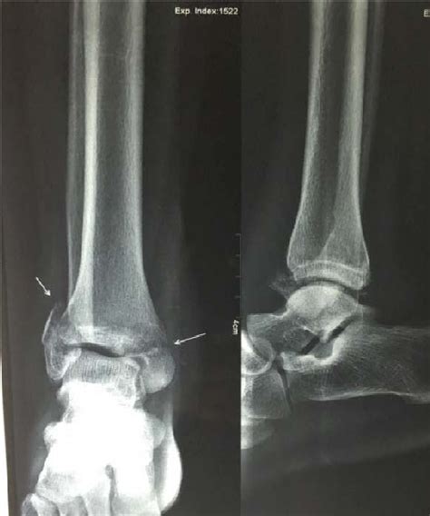 Figure 1 From The Functional Outcome Of Bimalleolar Fractures Treated