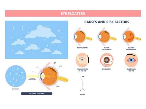 Black Spot in the Eye - An In-Depth look at Eye Floaters