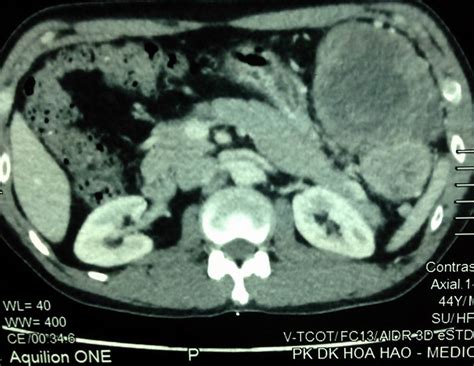 Vietnamese Medic Ultrasound Case Big Gastric Tumor Dr Phan Thanh