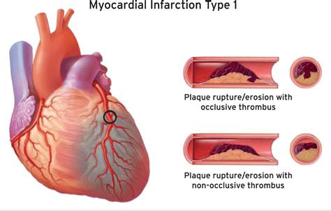 Figure From Fourth Universal Definition Of Myocardial Infarction