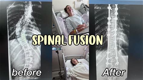 My Spinal Fusion Journey 3 Months Post Op Scoliosisspinal Fusion