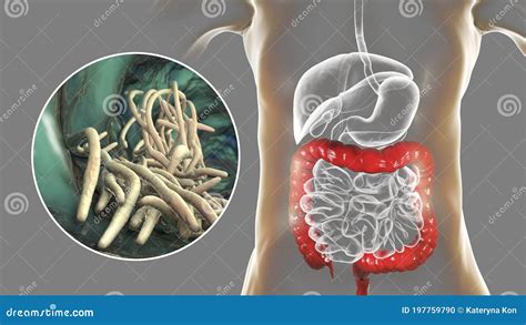 Vers Parasites Dans Le Gros Intestin Humain Illustration Stock