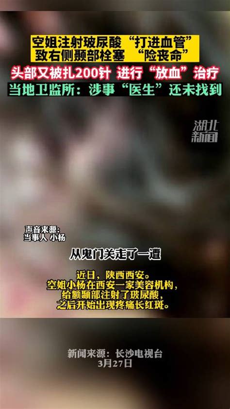 空姐注射玻尿酸打进血管险丧命 涉事医生消失 玻尿酸 血管 新浪新闻