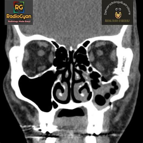 Blow Out Fracture Of The Orbit Radiology Case Radiogyan