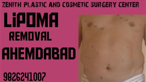 Lipoma Removal By Liposuction In Ahemdabad Baroda Anand Surat Rajkot