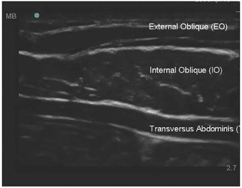 Ultrasound Guided Transversus Abdominis Plane Block And Quadratus Lumborum Block Anesthesia Key