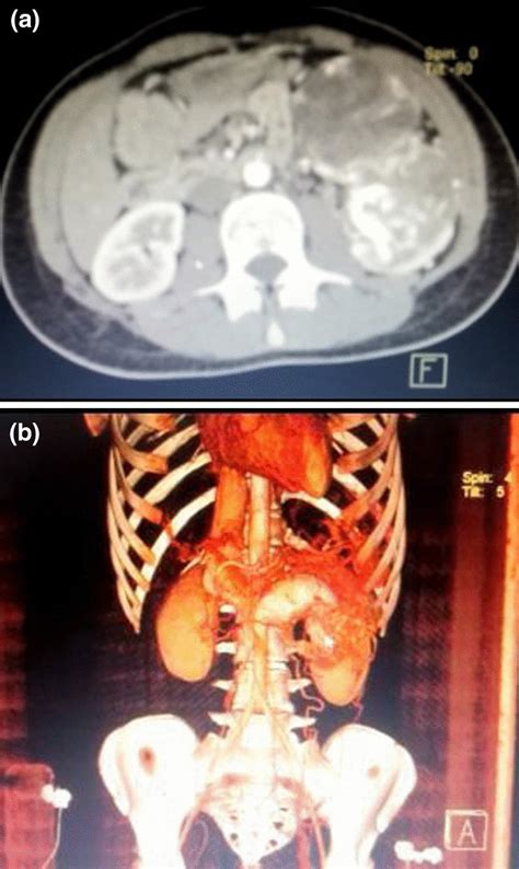 a Computed tomography CT scan of the abdomen showing a 7 5 3 cm³