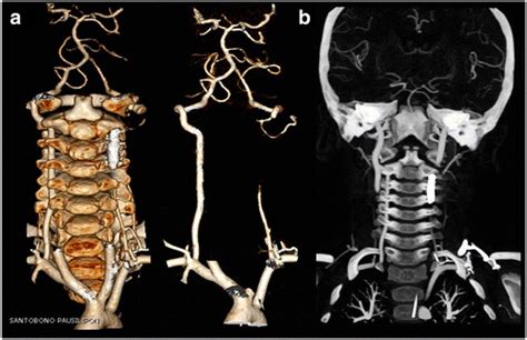 Ct Angiography On Volume Rendering A And Mpr Coronal Reformatted B