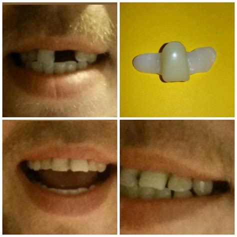 DIY Temporary Replacement Front Tooth Central Incisor - Other Oral Care