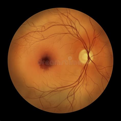 A Submacular Hemorrhage On The Retina As Observed During Ophthalmoscopy