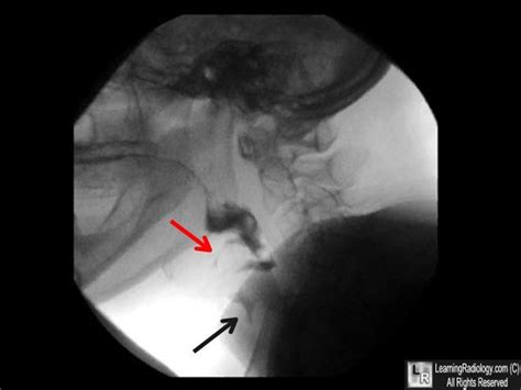 Video Fluoroscopic Swallowing Examination Aka Modified Barium Swallow