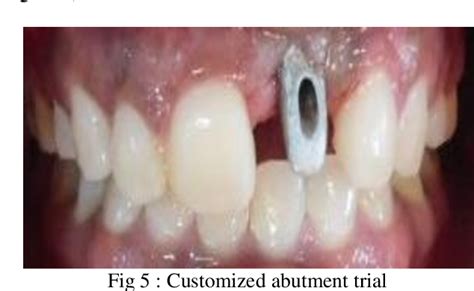 Figure From Prosthodontic Management Of Malpositioned Implants In