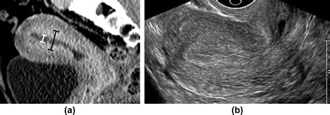 Performance Of Multidetector Ct In The Evaluation Of The Endometrium