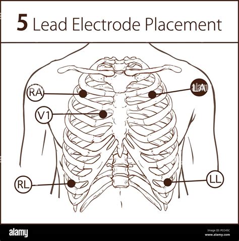 Holter Monitor 5 Lead Placement Diagram Wiring Diagram